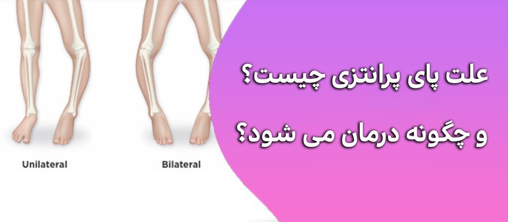 علت پای پرانتزی چیست و چگونه درمان می شود؟